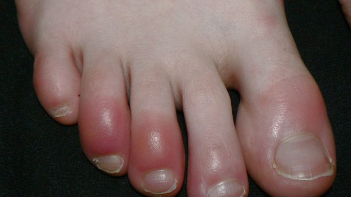 how to treat covid toes
