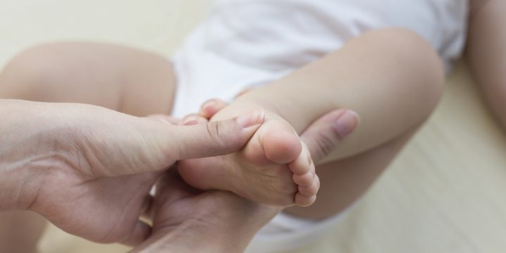 how to treat clubfoot