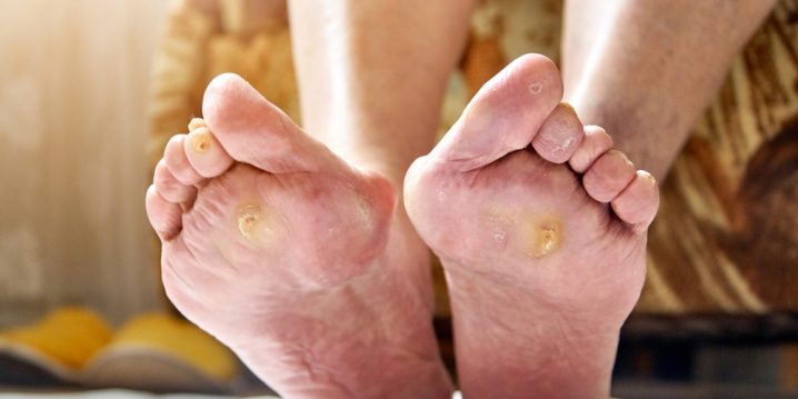 how to remove a callus from a diabetic foot