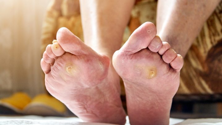 how to remove a callus from a diabetic foot