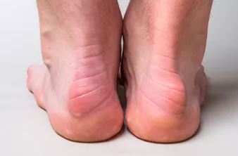how to treat haglunds deformity without surgery