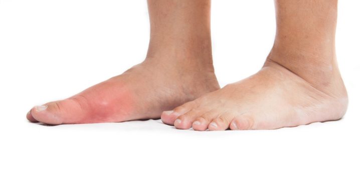 what is the difference between hallux rigidus and hallux valgus