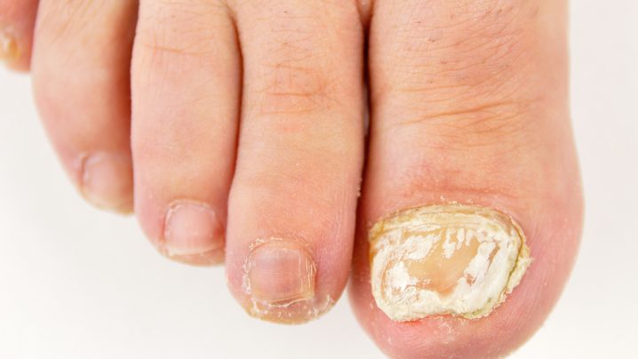 how long does onychomycosis take to heal?
